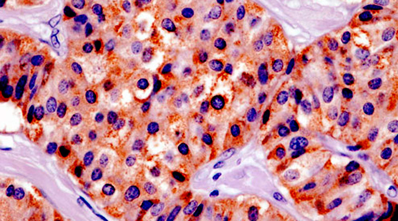 insulinoma